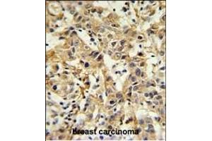CA6 Antibody (C-term) (ABIN653737 and ABIN2843041) IHC analysis in formalin fixed and paraffin embedded breast carcinoma followed by peroxidase conjugation of the secondary antibody and DAB staining. (CA6 Antikörper  (C-Term))