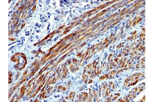 Formalin-fixed, paraffin-embedded human Leiomyosarcoma stained with SM-MHC Mouse Monoclonal Antibody (MYH11/923). (MYH11 Antikörper)