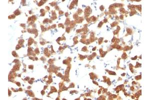 Formalin-fixed, paraffin-embedded human Thyroid Carcinoma stained with Cytokeratin 18 Mouse Monoclonal Antibody (C-04). (Cytokeratin 18 Antikörper)