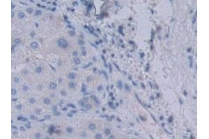 Detection of YARS in Human Liver cancer Tissue using Polyclonal Antibody to Tyrosyl tRNA Synthetase (YARS) (YARS Antikörper  (AA 2-528))