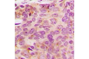 Immunohistochemical analysis of NDUFA3 staining in human breast cancer formalin fixed paraffin embedded tissue section. (NDUFA3 Antikörper  (Center))