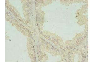 Immunohistochemistry of paraffin-embedded human prostate cancer using ABIN7147106 at dilution of 1:100 (RQCD1 Antikörper  (AA 1-258))