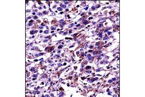 POU2F2 Antibody (N-term) ((ABIN657763 and ABIN2846741))immunohistochemistry analysis in formalin fixed and paraffin embedded human testis carcinoma followed by peroxidase conjugation of the secondary antibody and DAB staining. (Oct-2 Antikörper  (N-Term))