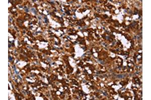 The image on the left is immunohistochemistry of paraffin-embedded Human thyroid cancer tissue using ABIN7190739(GAGE12I Antibody) at dilution 1/20, on the right is treated with synthetic peptide. (G Antigen 12I Antikörper)