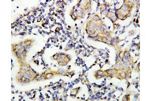 Anti-Caspase-8(P10) antibody, IHC(P) IHC(P): Human Mammary Cancer Tissue (Caspase 8 Antikörper  (C-Term))