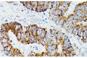 Immunohistochemistry of paraffin-embedded Human colon carcinoma using ETHE1 Polyclonal Antibody at dilution of 1:100 (40x lens). (ETHE1 Antikörper)