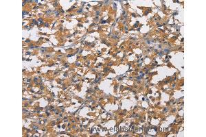 Immunohistochemistry of Human liver cancer using NT5E Polyclonal Antibody at dilution of 1:50 (CD73 Antikörper)