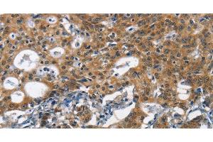 Immunohistochemistry of paraffin-embedded Human gasrtic cancer tissue using DCC Polyclonal Antibody at dilution 1:70 (DCC Antikörper)