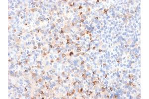 Formalin-fixed, paraffin-embedded Melanoma stained with Tyrosinase Rabbit Recombinant Monoclonal Antibody (TYR/2024R).