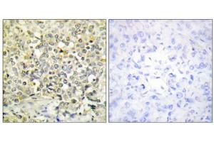Immunohistochemistry analysis of paraffin-embedded human lung carcinoma tissue using CDKL4 antibody. (CDKL4 Antikörper  (C-Term))