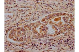 IHC image of ABIN7127333 diluted at 1:100 and staining in paraffin-embedded human liver cancer performed on a Leica BondTM system. (Rekombinanter ALDH2 Antikörper)