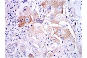 Immunohistochemical analysis of paraffin-embedded lung cancer tissues using IL1B mouse mAb with DAB staining. (IL-1 beta Antikörper)