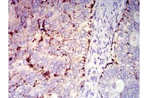 Immunohistochemical analysis of paraffin-embedded cervical cancer tissues using CD182 mouse mAb with DAB staining. (CXCR2 Antikörper)