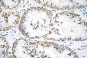 Immunohistochemistry was performed on paraffin-embedded human ovarian carcinoma using heat shock transcription factor 1 antibody (ABIN7798861), 1:200).