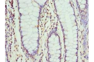 Immunohistochemistry of paraffin-embedded human colon cancer using ABIN7161336 at dilution of 1:100 (Neuromedin U Antikörper  (AA 35-174))