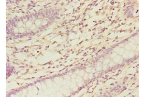 Immunohistochemistry of paraffin-embedded human colon cancer using ABIN7161139 at dilution of 1:100 (COBRA1 Antikörper  (AA 8-199))