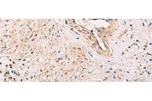 Immunohistochemistry of paraffin-embedded Human prost ate cancer tissue using PCYT2 Polyclonal Antibody at dilution of 1:55(x200) (PCYT2 Antikörper)