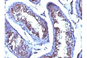 Formalin-fixed, paraffin-embedded human Testicular Carcinoma stained with Testosterone Mouse Monoclonal Antibody (4E1G2). (Testosterone Antikörper)