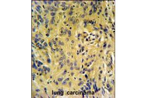 TESC Antibody IHC analysis in formalin fixed and paraffin embedded human lung carcinoma followed by peroxidase conjugation of the secondary antibody and DAB staining. (Tescalcin Antikörper  (C-Term))