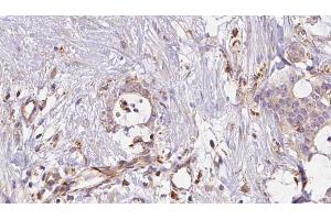 ABIN6273043 at 1/100 staining Human liver cancer tissue by IHC-P. (ERO1LB Antikörper  (Internal Region))