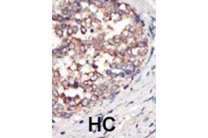 Formalin-fixed and paraffin-embedded human cancer tissue reacted with the primary antibody, which was peroxidase-conjugated to the secondary antibody, followed by AEC staining. (PIK3 gamma Antikörper  (C-Term))
