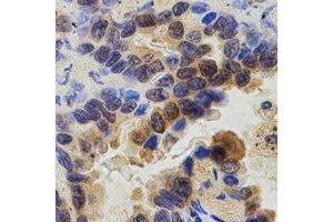 Immunohistochemical analysis of ZAP70 staining in human lung cancer formalin fixed paraffin embedded tissue section. (ZAP70 Antikörper  (C-Term))