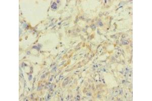 Immunohistochemistry of paraffin-embedded human pancreatic cancer using ABIN7164521 at dilution of 1:100 (SMARCA2 Antikörper  (AA 700-1216))