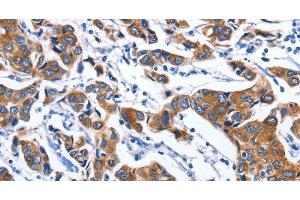 Immunohistochemistry of paraffin-embedded Human breast cancer tissue using MYH1 Polyclonal Antibody at dilution 1:40 (MYH1 Antikörper)