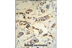 C1QA Antibody (C-term) (R) IHC analysis in formalin fixed and paraffin embedded human breast carcinoma tissue followed by peroxidase conjugation of the secondary antibody and DAB staining. (C1QA Antikörper  (C-Term))