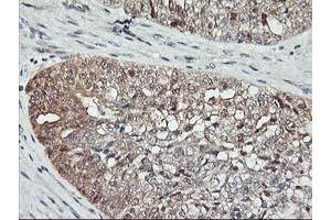 Immunohistochemical staining of paraffin-embedded Adenocarcinoma of Human ovary tissue using anti-ASCC1 mouse monoclonal antibody.