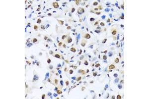 Immunohistochemistry of paraffin-embedded human lung cancer using OTP antibody (ABIN6132447, ABIN6145083, ABIN6145084 and ABIN6217092) at dilution of 1:100 (40x lens). (OTP Antikörper  (AA 1-130))