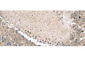 Immunohistochemistry of paraffin-embedded Human liver cancer tissue using KCTD7 Polyclonal Antibody at dilution of 1:55(x200) (KCTD7 Antikörper)