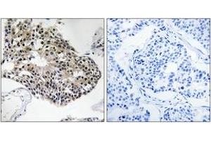 Immunohistochemistry analysis of paraffin-embedded human breast carcinoma tissue, using RPS25 Antibody. (RPS25 Antikörper  (AA 76-125))