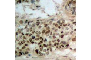 Immunohistochemical analysis of WWOX (pY33) staining in human breast cancer formalin fixed paraffin embedded tissue section. (WWOX Antikörper  (N-Term, pTyr33))