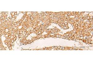 Immunohistochemistry of paraffin-embedded Human liver cancer tissue using KRT9 Polyclonal Antibody at dilution of 1:30(x200) (KRT9 Antikörper)