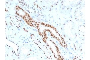 Formalin-fixed, paraffin-embedded human Renal Cell Carcinoma stained with PAX8 Mouse Monoclonal Antibody (PAX8/1491). (PAX8 Antikörper  (AA 60-261))