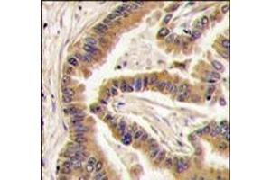 Formalin-fixed and paraffin-embedded human lung carcinoma tissue reacted with CK1a antibody (C-term), which was peroxidase-conjugated to the secondary antibody, followed by DAB staining. (CSNK1A1 Antikörper  (C-Term))