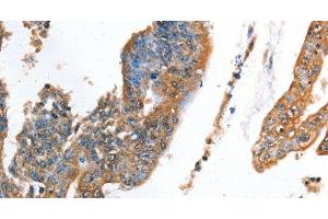 Immunohistochemistry of paraffin-embedded Human colon cancer using AKR1D1 Polyclonal Antibody at dilution of 1:35 (AKR1D1 Antikörper)