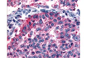 Anti-GRM6 / MGLUR6 antibody IHC of human Lung, Non-Small Cell Carcinoma. (Metabotropic Glutamate Receptor 6 Antikörper  (N-Term))