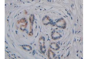 DAB staining on IHC-P;;Samples: Human Pancreatic cancer Tissue (GPLD1 Antikörper  (AA 496-840))