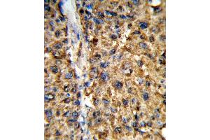 Formalin-fixed and paraffin-embedded human hepatocarcinoma reacted with GSTA2 Antibody (N-term), which was peroxidase-conjugated to the secondary antibody, followed by DAB staining. (GSTa2 Antikörper  (N-Term))