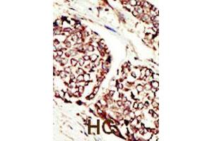 Formalin-fixed and paraffin-embedded human hepatocellular carcinoma tissue reacted with ERBB3 polyclonal antibody  , which was peroxidase-conjugated to the secondary antibody, followed by DAB staining. (ERBB3 Antikörper  (N-Term))