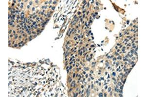 The image on the left is immunohistochemistry of paraffin-embedded Human esophagus cancer tissue using ABIN7190243(CHGB Antibody) at dilution 1/30, on the right is treated with synthetic peptide. (CHGB Antikörper)