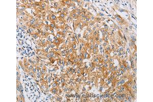 Immunohistochemistry of Human esophagus cancer using IFITM3 Polyclonal Antibody at dilution of 1:25 (IFITM3 Antikörper)