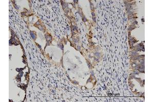Immunoperoxidase of monoclonal antibody to GLUD2 on formalin-fixed paraffin-embedded human ovarian cancer. (GLUD2 Antikörper  (AA 1-264))
