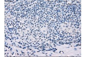 Immunohistochemical staining of paraffin-embedded Adenocarcinoma of colon tissue using anti-SSX2mouse monoclonal antibody. (SSX2 Antikörper)