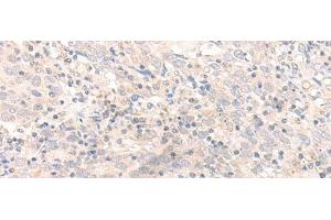 Immunohistochemistry of paraffin-embedded Human cervical cancer tissue using IL26 Polyclonal Antibody at dilution of 1:30(x200) (IL-26 Antikörper)