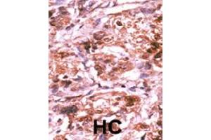 Formalin-fixed and paraffin-embedded human hepatocellular carcinoma tissue reacted with CDC25A (phospho S293) polyclonal antibody  which was peroxidase-conjugated to the secondary antibody followed by AEC staining.
