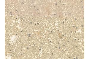 ABIN6257849 and ABIN6275297 at 1/100 staining human glioblastoma by IHC-P.