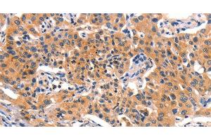 Immunohistochemistry of paraffin-embedded Human lung cancer using AMY2A Polyclonal Antibody at dilution of 1:50
